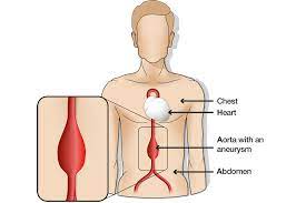 Aortic Aneurysm Screening